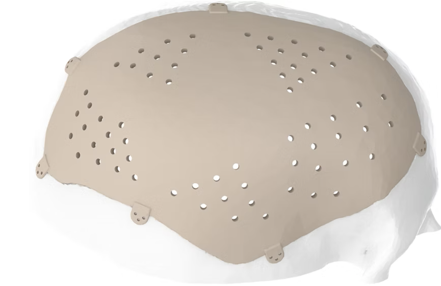 Οστικά Μοσχεύματα Κρανίου (custom made)